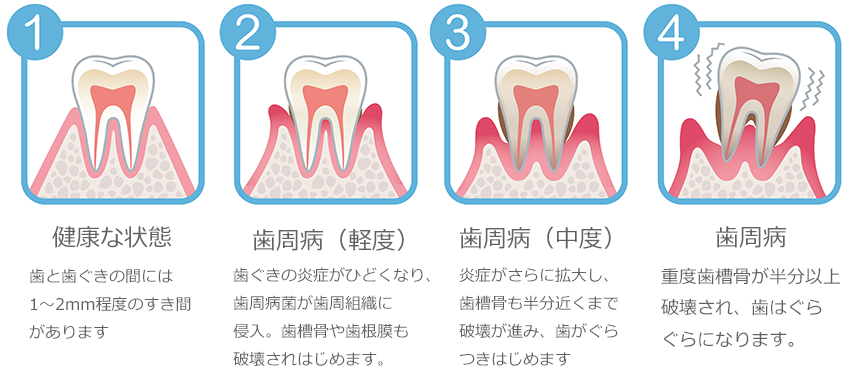 歯周病治療2